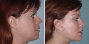 Dr. Kao Ponytail Facelift