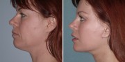Dr. Kao Ponytail Facelift
