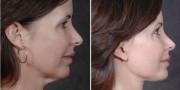 Dr. Kao Ponytail Facelift