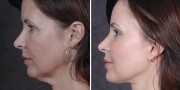 Dr. Kao Ponytail Facelift