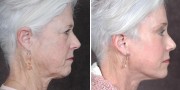 Dr. Kao Ponytail Facelift