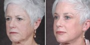 Dr. Kao Ponytail Facelift