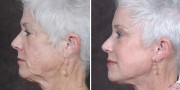 Dr. Kao Ponytail Facelift