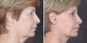 Dr. Kao Ponytail Facelift