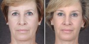 Dr. Kao Ponytail Facelift