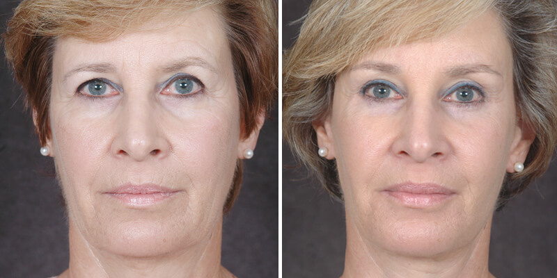 Dr. Kao Ponytail Facelift
