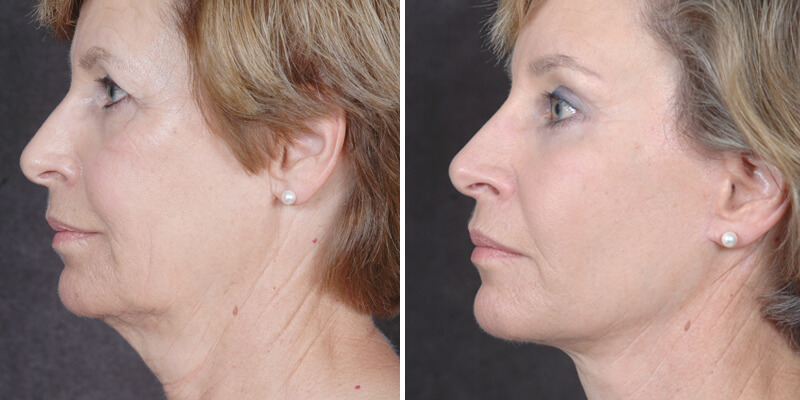 Dr. Kao Ponytail Facelift