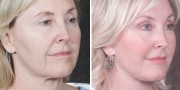 Dr. Kao Ponytail Facelift