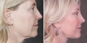 Dr. Kao Ponytail Facelift