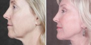 Dr. Kao Ponytail Facelift