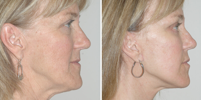 Dr. Kao Ponytail Facelift