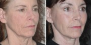 Dr. Kao Ponytail Facelift