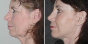 Dr. Kao Ponytail Facelift