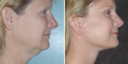 Dr. Kao Ponytail Facelift