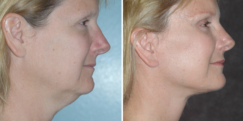 Dr. Kao Ponytail Facelift