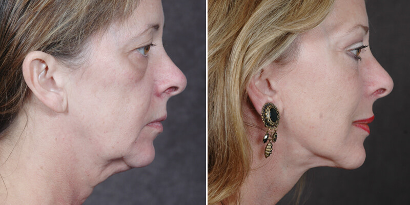 Dr. Kao Ponytail Facelift