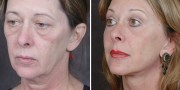 Dr. Kao Ponytail Facelift