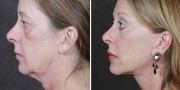 Dr. Kao Ponytail Facelift