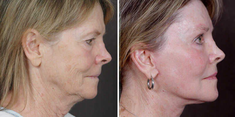 Dr. Kao Ponytail Facelift