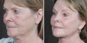 Dr. Kao Ponytail Facelift