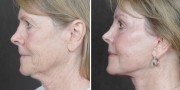 Dr. Kao Ponytail Facelift