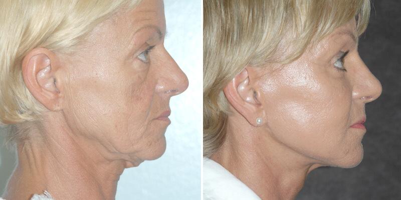 Dr. Kao Ponytail Facelift