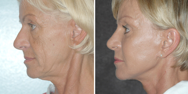 Dr. Kao Ponytail Facelift