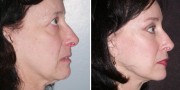 Dr. Kao Ponytail Facelift