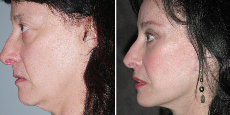 Dr. Kao Ponytail Facelift