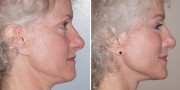 Dr. Kao Ponytail Facelift