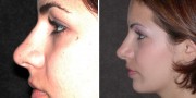 Dr. Kao Rhinoplasty