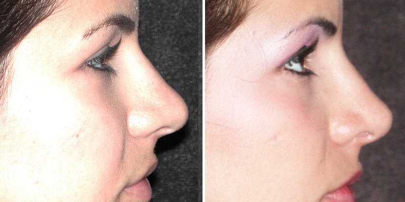 Dr. Kao Rhinoplasty