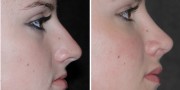 Dr. Kao Rhinoplasty