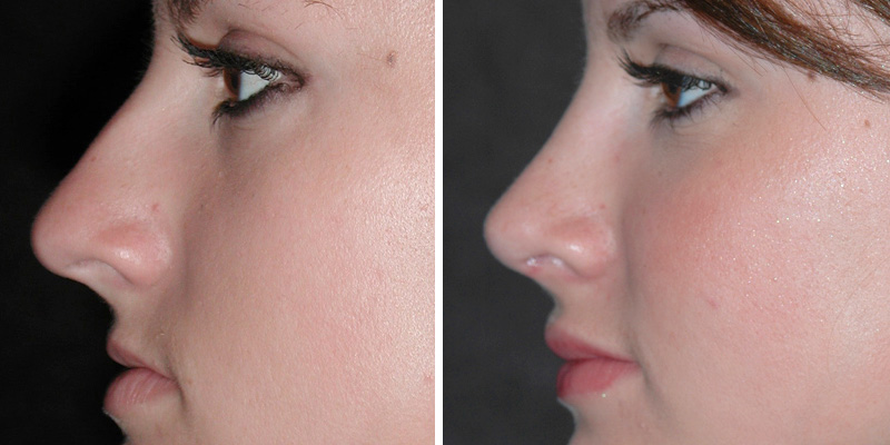 Dr. Kao Rhinoplasty