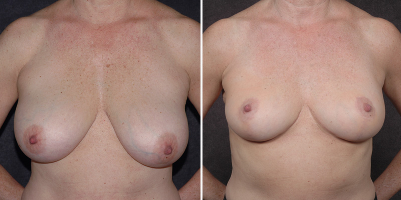 Dr. Kao Breast Lift