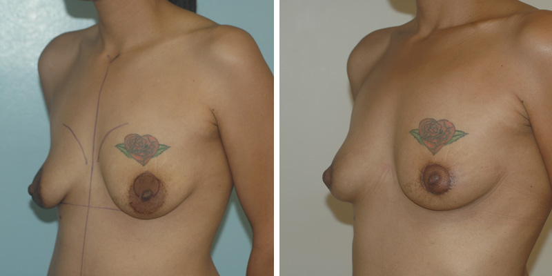 Dr. Kao Breast Lift