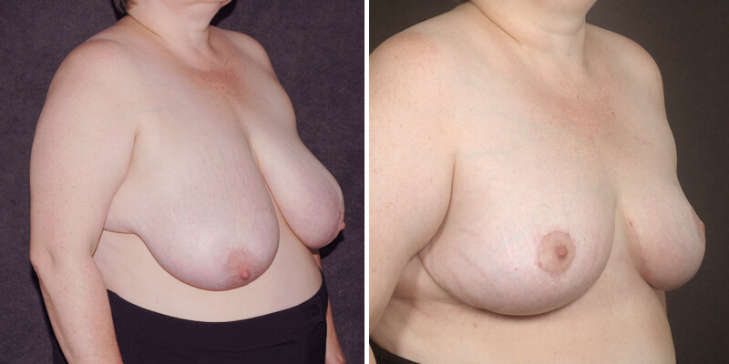 Dr. Kao Breast Reduction