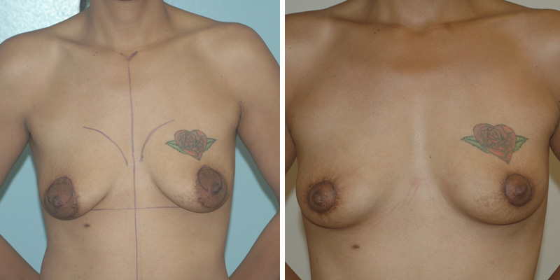 Dr. Kao Breast Lift