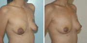 Dr. Kao Breast Lift