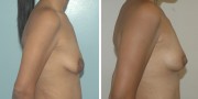 Dr. Kao Breast Lift