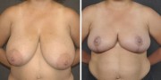 Dr. Kao Breast Reduction