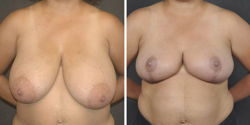 Dr. Kao Breast Reduction