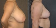 Dr. Kao Breast Reduction