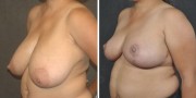 Dr. Kao Breast Reduction