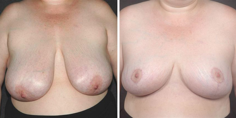 Dr. Kao Breast Reduction