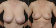 Dr. Kao Breast Reduction