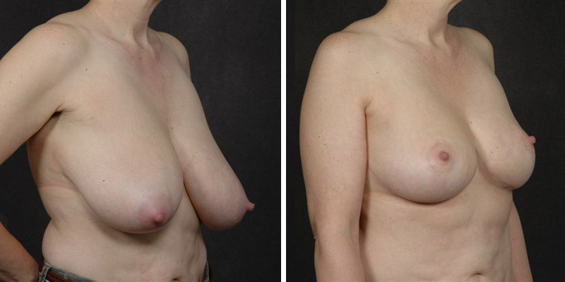 Dr. Kao Breast Reduction