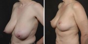 Dr. Kao Breast Reduction