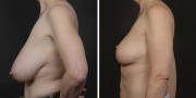 Dr. Kao Breast Reduction