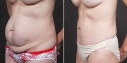 Dr. Kao Tummy Tuck (Abdominoplasty)